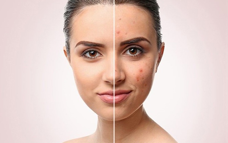 Các Vị Trí Mọc Mụn Trên Gương Mặt